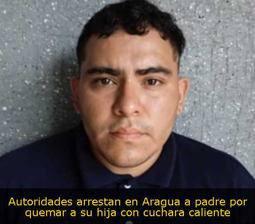 Autoridades arrestan en Aragua a padre por quemar a su hija con cuchara caliente 