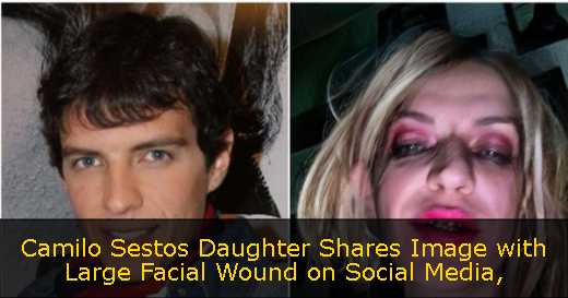 Camilo Sestos Daughter Shares Image with Large Facial Wound on Social Media
