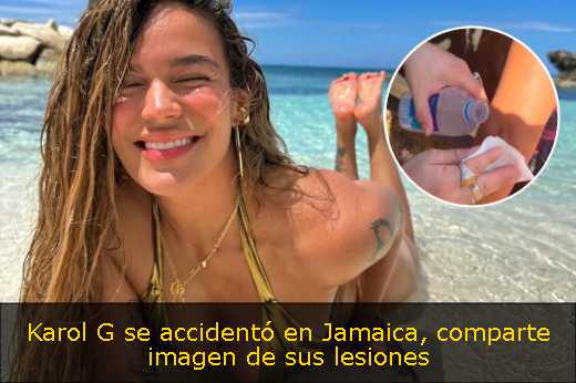 Karol G se accidentó en Jamaica, comparte imagen de sus lesiones 